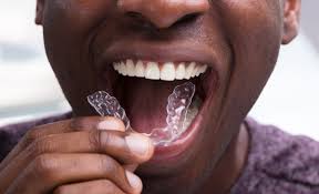 Content updated daily for no braces teeth straightening How To Straighten Your Teeth Without Braces Impressions Smile