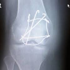 How I Coped With A Broken Kneecap Broken Knee Cap Knee Fracture Knee Injury Recovery
