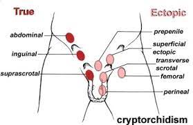 About half of all cases of testicular cancer are in men between the. Urology Cryptorchidism Testicular Torsion Hydrocele Varicocele Flashcards Quizlet