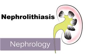 Image result for Nephrolithiasis