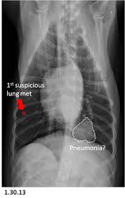 Shortness of breath or becoming easily winded are also possible symptoms of lung cancer. An Update On Treating Lung Metastasis In Dogs Tripawds
