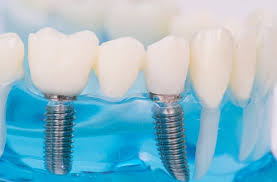 Implan gigi sendiri merupakan pembuatan akar gigi buatan yang ditanam pada rahang untuk mengganti akar gigi yang hilang atau rusak. Dental Implant Klinik Bina Sehat