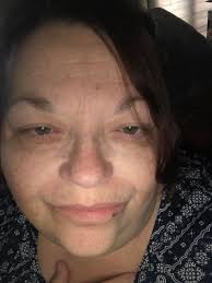 Sarcoidosis symptoms in sunny Atlanta January