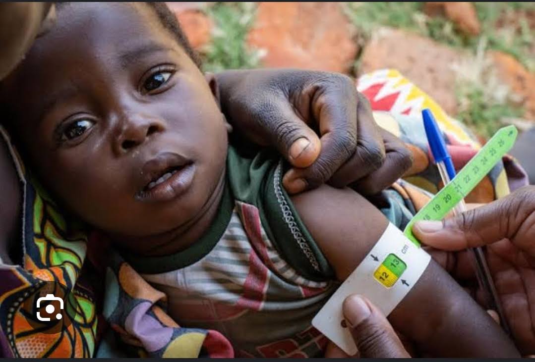 Severe Acute Malnutrition product image