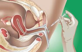 The advantage about a blood test is that you can take the test within 7 to. Intrauterine Insemination Iui American Pregnancy Association