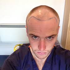 Jason Steele's Hair Transplant: A Journey to Regrowth