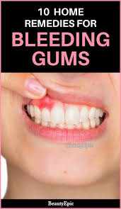 How To Treat Bleeding Gums 10 Home Remedies To Try Bleeding Gum Home Remedies Remedies
