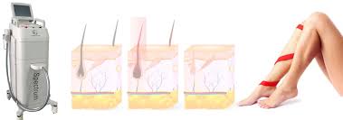 Laser hair removal can be done for beard shaping or permanent facial hair removal those who wants to achieve a lasting groomed appearing. The Most Advanced Laser Hair Removal Machine Nova