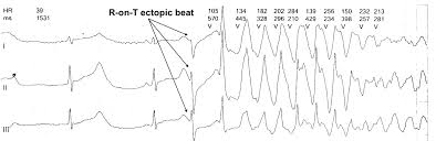 Long Qt Syndromes And Torsade De Pointes The Cardiology Advisor