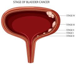 Image result for Bladder Cancer