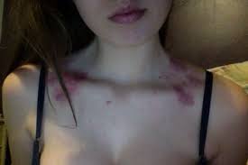 Love Bites Love Bites Hickies Hickeys Love Bites