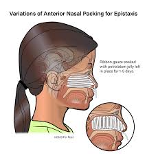 Image result for Nasal Packing