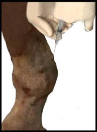 Image result for Tendon Sheath Injection
