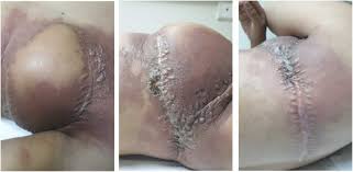 Image result for zoster under breasts