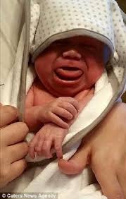 Baby Born With Tongue Twice The Size Of Her Mouth Finally Learns To Laugh  After Surgery