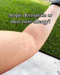 Image result for mite bites on humans