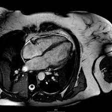 We did not find results for: Ressonancia Magnetica Rm Do Coracao Ou Cardiaca Exames De Rm