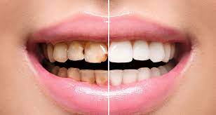 Wussten Sie Dass Karies Die Weltweit Am Haufigsten Vorkommende Krankheit Ist Dr Jorg Peterke