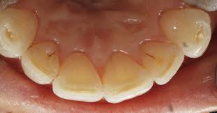 Image result for Tooth Abrasion