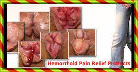 How To Treatment Hemorrhoids At Home Hemorrhoids During Pregnancy