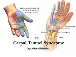 Carpal tunnel syndrome can cause pain and other symptoms in the hand. Carpal Tunnel Syndrome Definition And Treatment All In All News