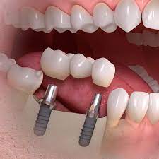 Implants Can Replace Any Or All Of Your Teeth Our Role Is Placement Of Implants And Restoring The Integrat Dental Implants Dental Surgery Dental Implants Cost