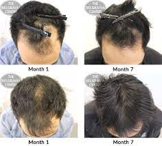 Well there is one thing that we could consider: Hair Growth Success Great Results In Just A Few Months