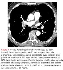 Verre dépoli micronodulaire généralisé b b (expiration) : Comment Je Fais Un Scanner Simple Energie Pour Embolie Pulmonaire Aigue Epa