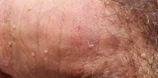Image result for genital warts