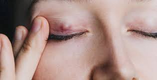 The cold helps in constricting blood vessels, thereby reducing swelling. Six Home Remedies For Eye Stye Women S Best Blog