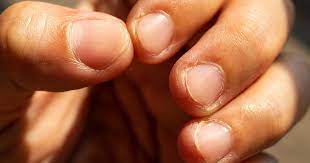 Darier disease is a rare genetic disorder that causes a skin rash and appears mostly in adolescence. 7 Nail Symptoms And Conditions You Shouldn T Ignore Today