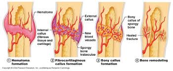 Speed Healing Of Bone Fracture Bone Healing Fracture Healing Bone Fracture