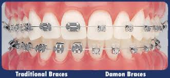 Traditional Braces Vs The Damon System Braces Traditional Braces Damon Braces Braces
