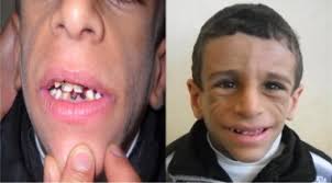 Pronunciation of the word(s) berardinelli seip syndrome. Berardinelli Seip Syndrome Type 2 An Egyptian Child Sciencedirect
