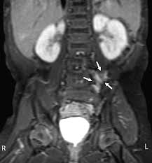 Integrated Imaging Using MRI and 123| Metaiodobenzylguanidine Scintigraphy  to Improve Sensitivity and Specificity in the Diagnosis of Pediatric  Neuroblastoma | AJR