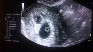 We did not find results for: 6 Week Twin Ultrasound Surrogacy Twin Update Youtube
