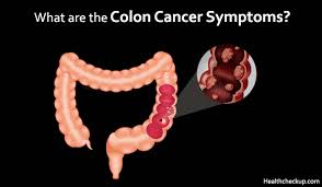 Find out about symptoms and risk factors for colon cancer, also called colorectal cancer. Colon Cancer Symptoms And Stages In Males Females