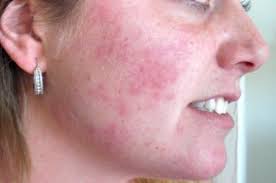 In hot weather, dress in loose, lightweight clothing that wicks moisture away from your skin. Home Remedies To Treat Rashes On Face Face Rash Remedies Rashes Remedies Rash On Face