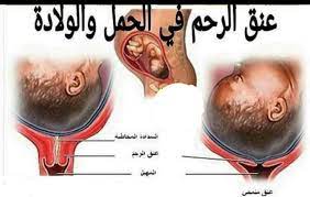 وقد تؤدي الأعداد المفرطة من الصفائح الدموية و/ أو الصفائح الدموية الطبيعية التي تستجيب لشذوذ جدران الأوعية الدموية إلى الخثار. Ø´ÙƒÙ„ Ø³Ø¯Ø§Ø¯Ø© Ø§Ù„Ø±Ø­Ù…