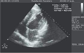 Evaluación de la válvula aórtica: Eco Doppler Cardiaco Color Download Scientific Diagram