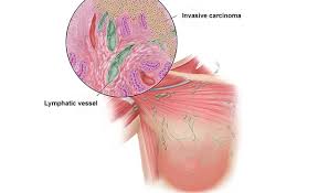 Ongoing research, especially at the molecular level, will increase our understanding of how inflammatory breast cancer begins and progresses. Breast Cancer 101 From Incidence To Treatment Cancer Therapy Advisor