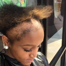 / lines that radiate outward from a single point. Atlanta Hairstylist S Viral Video Shocks Social Media With Extreme Hair Loss Caused By Weaves The Charleston Chronicle
