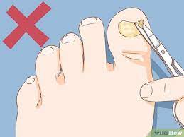 Einen Zehennagel Schnell Nachwachsen Lassen 15 Schritte Mit Bildern Wikihow