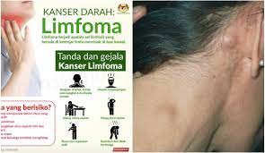 Sakit yang dirasakan boleh menjadi tanda bahawa kanser telah merebak ke bahagian lain dari tubuh. Benjolan Ini Tanda Tanda Kanser Limfoma Anda Mungkin Tak Sedar Mykmu Net