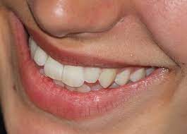 Fixed/bonded retainers are permanent retainers that are most often prescribed for lower teeth, especially for. Miami Orthodontist Explains Orthodontic Relapse