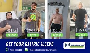 During the gastric sleeve procedure, the left side of the stomach is cut. Gastric Sleeve Surgery In Tijuana Mexico Jet Medical Tourism