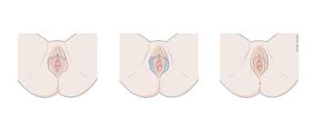 Intimchirurgie bei der Frau | Klinik Pyramide