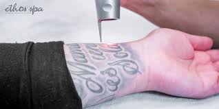 Why Is Your Laser Tattoo Removal Not Working?