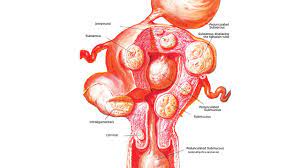Its vague, insidious onset means that it tends not to present until it is too late, and there is currently no effective screening programme in place to ovarian cancer tends to present with a pelvic mass, so i've included a differential diagnosis for this. Herbal Treatment Of Uterine Fibroids Part 4 The Guardian Nigeria News Nigeria And World News Features The Guardian Nigeria News Nigeria And World News