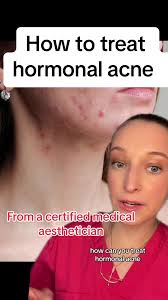 How to treat hormonal acne ‼️ ##hormonalacne #hormonalacnejourney  #hormonalacnesolution #greenscreen